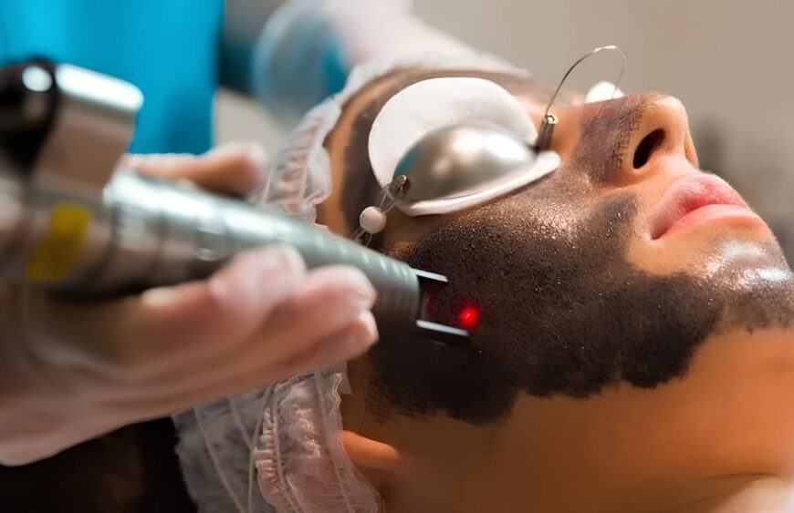 Hollywood Peel - Carbon Peel (Facial de rejuvenecimiento)