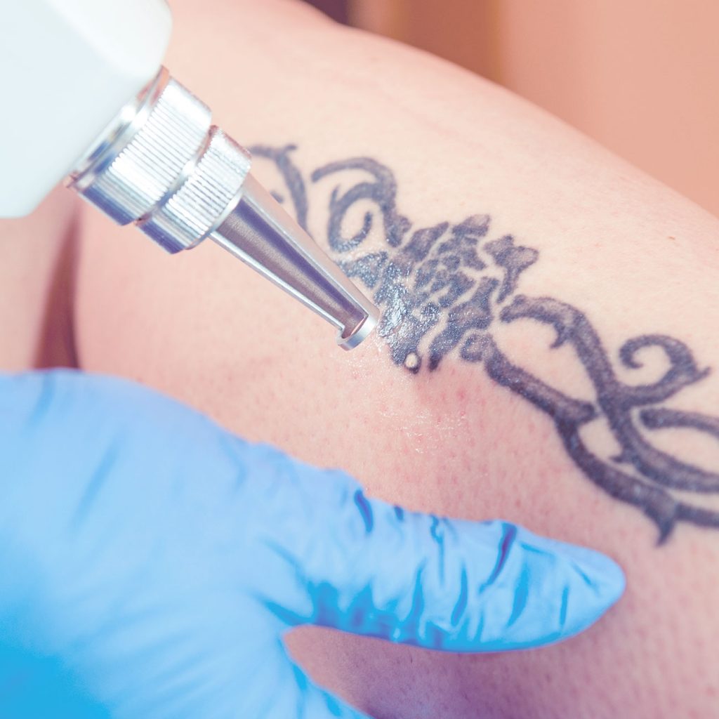 Eliminación de tatuajes - Agenda tu cita para valoración